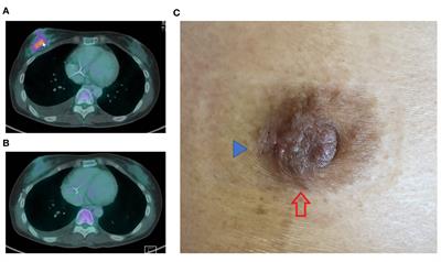 Case report: Metastatic ovarian mucinous carcinoma to the breast: diagnostic challenges and pitfalls